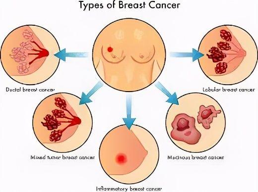 乳腺癌最新指南，全面理解、预防与应对的综合策略